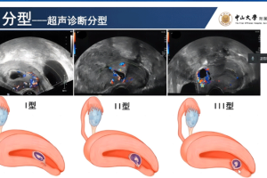 瘢痕妊娠