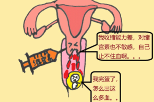 清宫手术