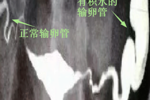输卵管积水
