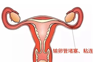 输卵管粘连